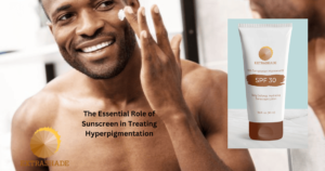 Sunscreen in Treating Hyperpigmentation